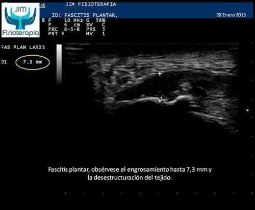 Fascitis plantar