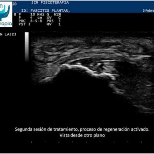 Tratamiento fascitis plantar