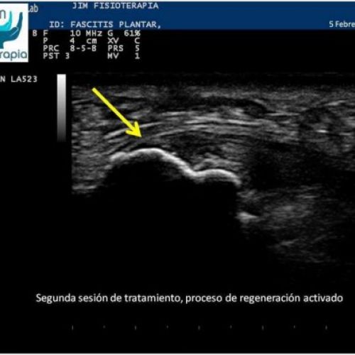 Tratamiento de fascitis plantar