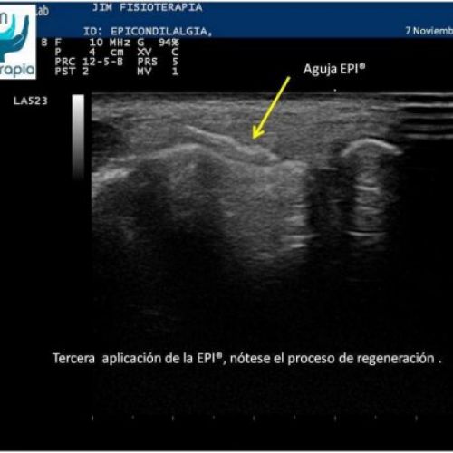 Tratamiento de epicondilitis