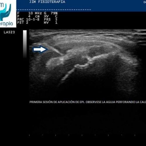 Tratamiento con EPI® de Tendinosis Calcificada