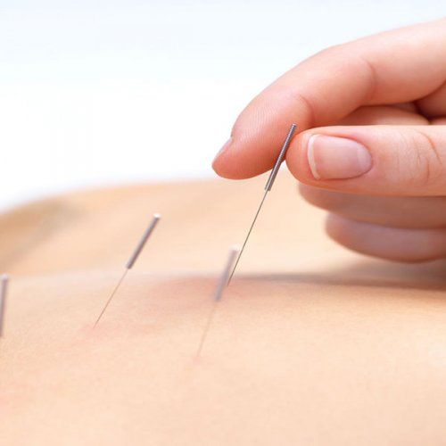 Acupuntura en Madrid