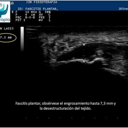 Tratamiento de fascitis plantar con EPI®