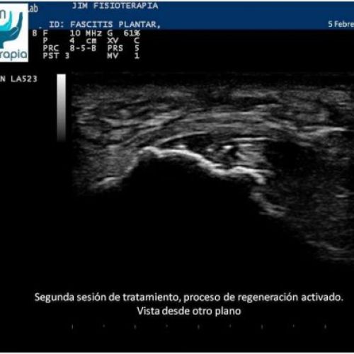 Tratamiento fascitis plantar