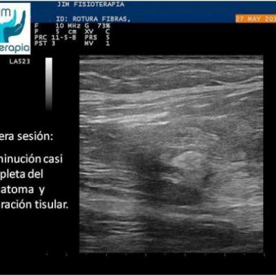 rotura muscular con epi