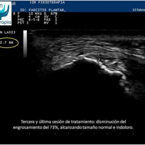 plantar Tratamiento fascitis