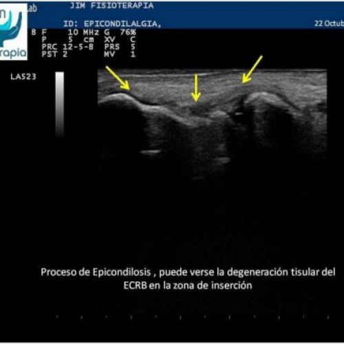 Tratamiento de epicondilitis EPI®