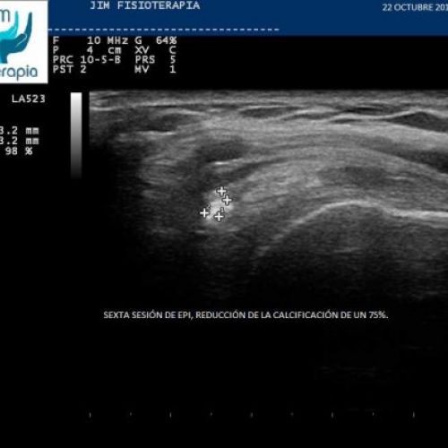 Tratamiento con EPI® Tendinosis Calcificada del Supraespinoso