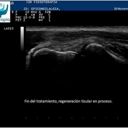 Tratamiento epicondilitis EPI®