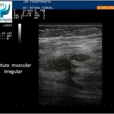 tratamiento de rotura muscular con epi