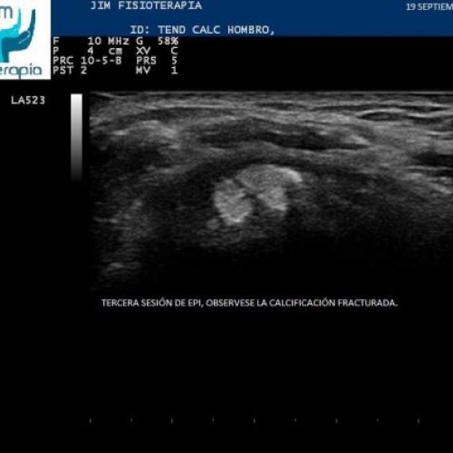 Tratamiento con EPI® de Tendinosis Calcificada del Supraespinoso