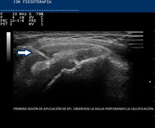 Tendinosis Calcificada del Supraespinoso