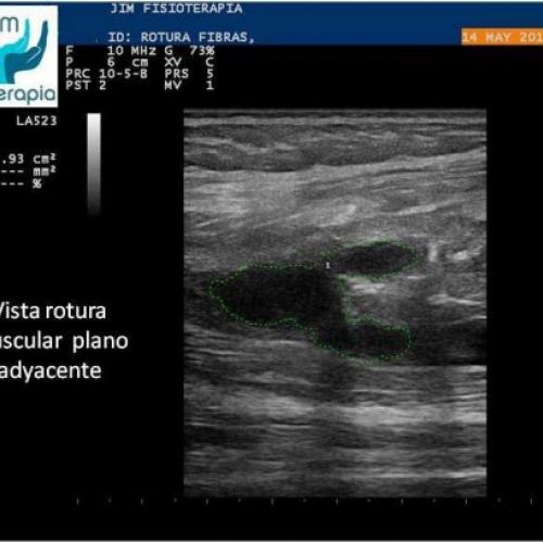 tratamiento de rotura muscular epi