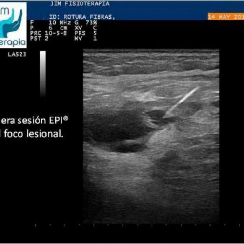 tratamiento rotura muscular con epi