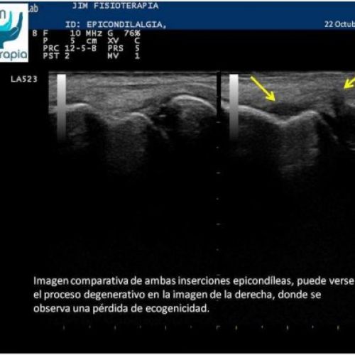 Tratamiento de epicondilitis con EPI®